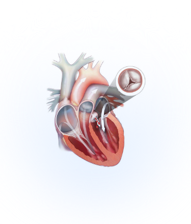 Heart with aortic regurgitation