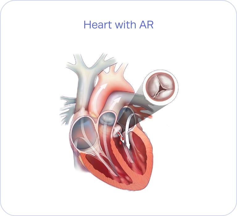 Heart with AR