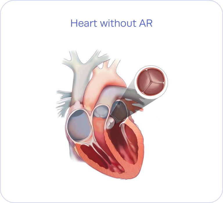 Heart without AR