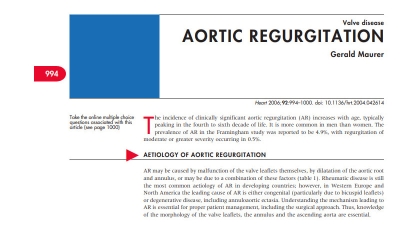 Valve Disease: Aortic Regurgitation